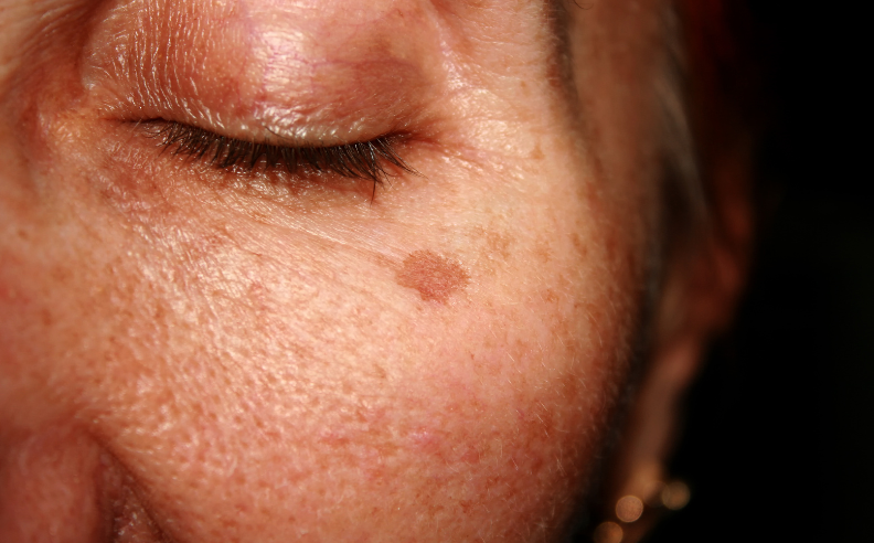 taches brunes sur une partie du visage d'une femme