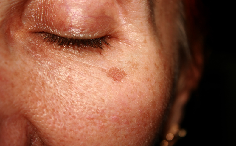 Comment se débarrasser des taches brunes sur le visage ?