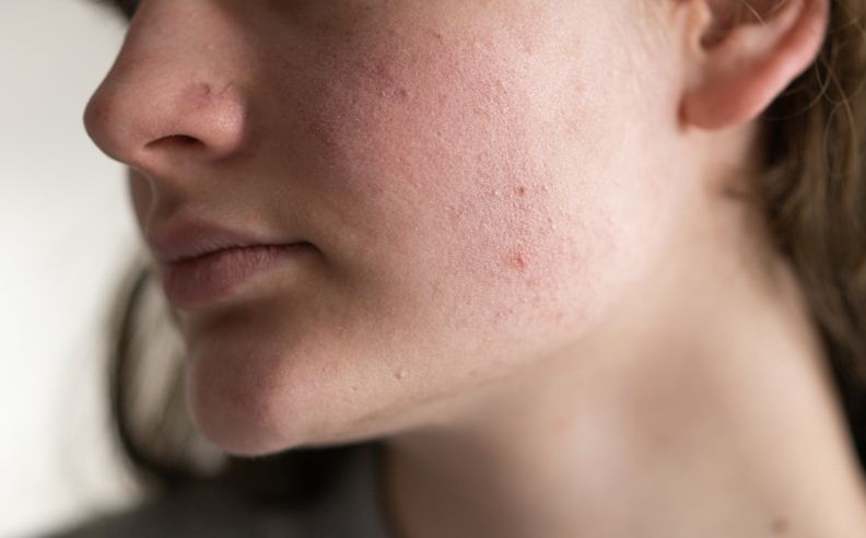 Zoom sur peau irritée