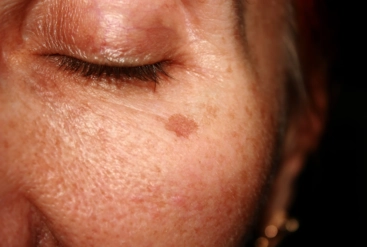 taches brunes sur une partie du visage d'une femme
