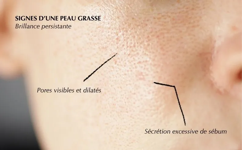 Les signes d'une peau grasse et zoom sur peau