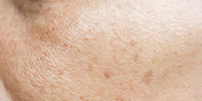 Comment se débarrasser des taches brunes sur le visage ?