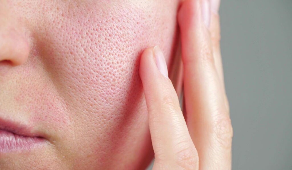 Pores dilatés : comment en prendre soin naturellement ?