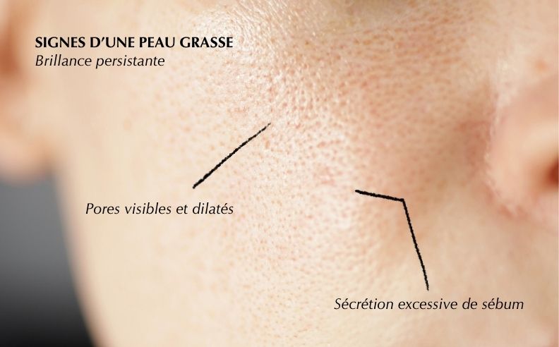 Quelle routine beauté adopter lorsqu’on a la peau grasse ?